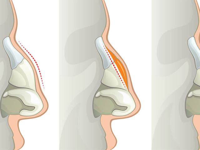 Burun estetiğinde planlama – konuyu anlatan temsili görsel, Prof. Dr. Serdar Öztürk, Ankara